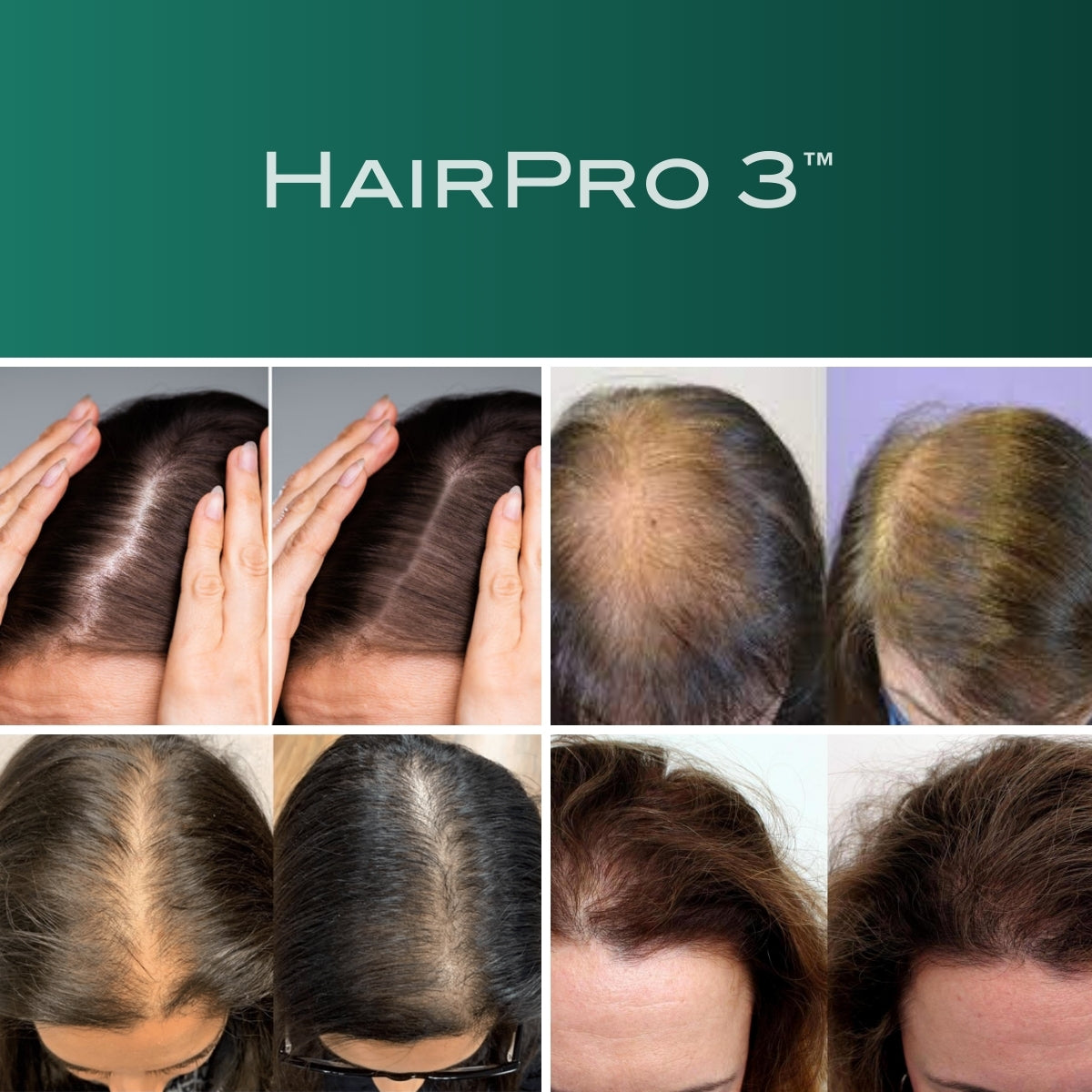 HairPro 3™ - מסרק מתקדם לבריאות השיער: מונע נשירה ומעודד צמיחה